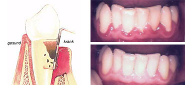 Parodontose - Behandlung